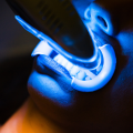 Blanqueamiento dental completo: ¿Cuáles son sus ventajas?
